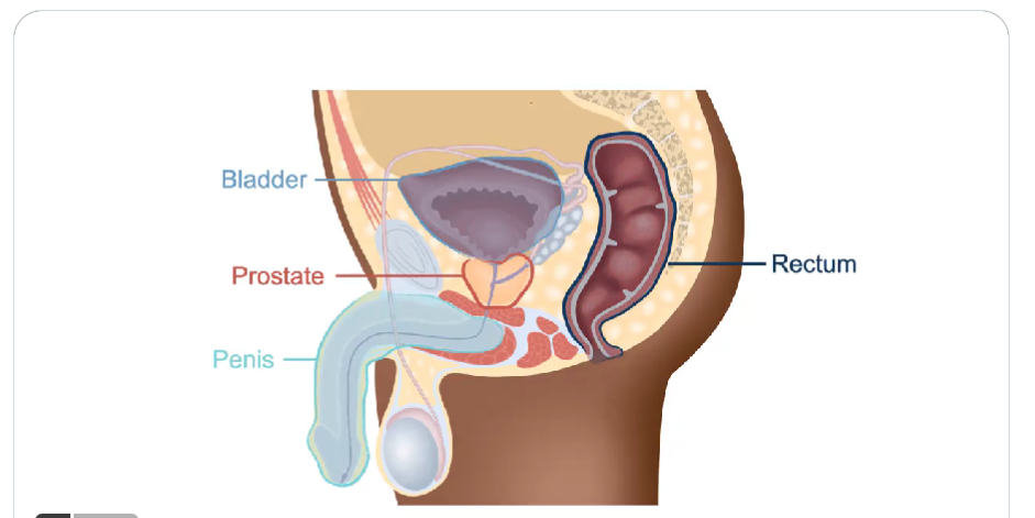 benign prostatic hyperplasia